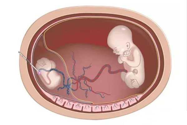 阿坝卵巢性闭经试验_试管婴儿双胞胎减胎风险有哪些？了如指掌，才能胜券在