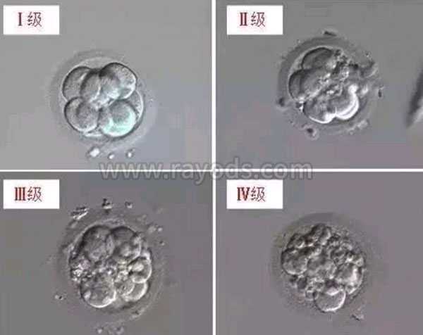青岛借卵生子会有遗传病吗_试管婴儿胚胎等级是怎么划分的